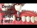 डेंटल इमपलाट क्या है? कितना खर्च कितना समय ? dental implant process.