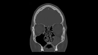 Maxillary Sinus Atelectasis (Silent Sinus Syndrome)