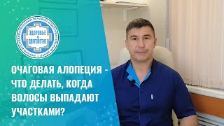 😲 Очаговая алопеция  что делать, когда волосы выпадают участками?