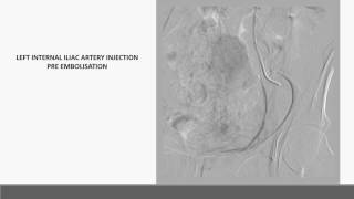 Preoperative sacral tumor embolisation