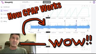 👀 Watch How CPAP Works While you Sleep using SleepHQ or OSCAR