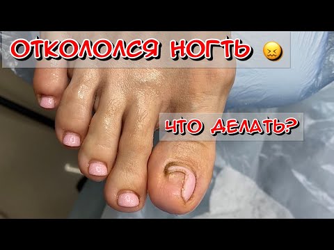 Откололся ноготь что делать? Почему ноготь не прирастает? Зачистка ногтя