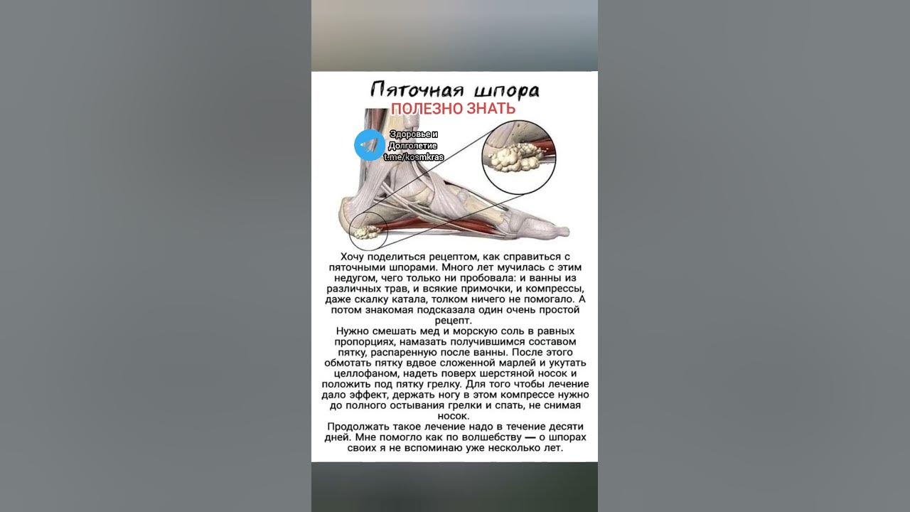 Как избавиться от шпоры в пятке быстро. Пяточная шпора | Симптомы | Диагностика | Лечение - Lik.ua Пяточная шпора — болючий «шип» в ноге. 13 быстрых и эффективных. Пяточная шпора (плантарный фасциит) – причины, симптомы, диагностика.