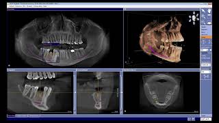 Sicat - Planning Implants In Sicat