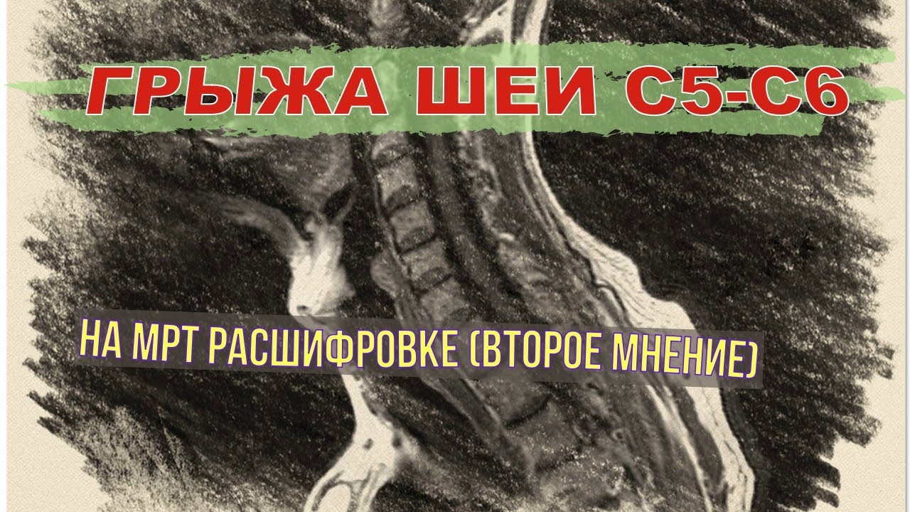 ГРЫЖА шейного отдела ПОЗВОНОЧНИКА С5 С6 и левосторонний СКОЛИОЗ 1 ...