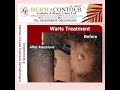 Warts Treatment by a German Trained Cosmetic Dermatologist in Abuja Nigeria 🇳🇬 @DermacontourTv