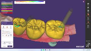 Implant Bridge Design in exocad | Full Digital Workflow | Dental CAD/CAM