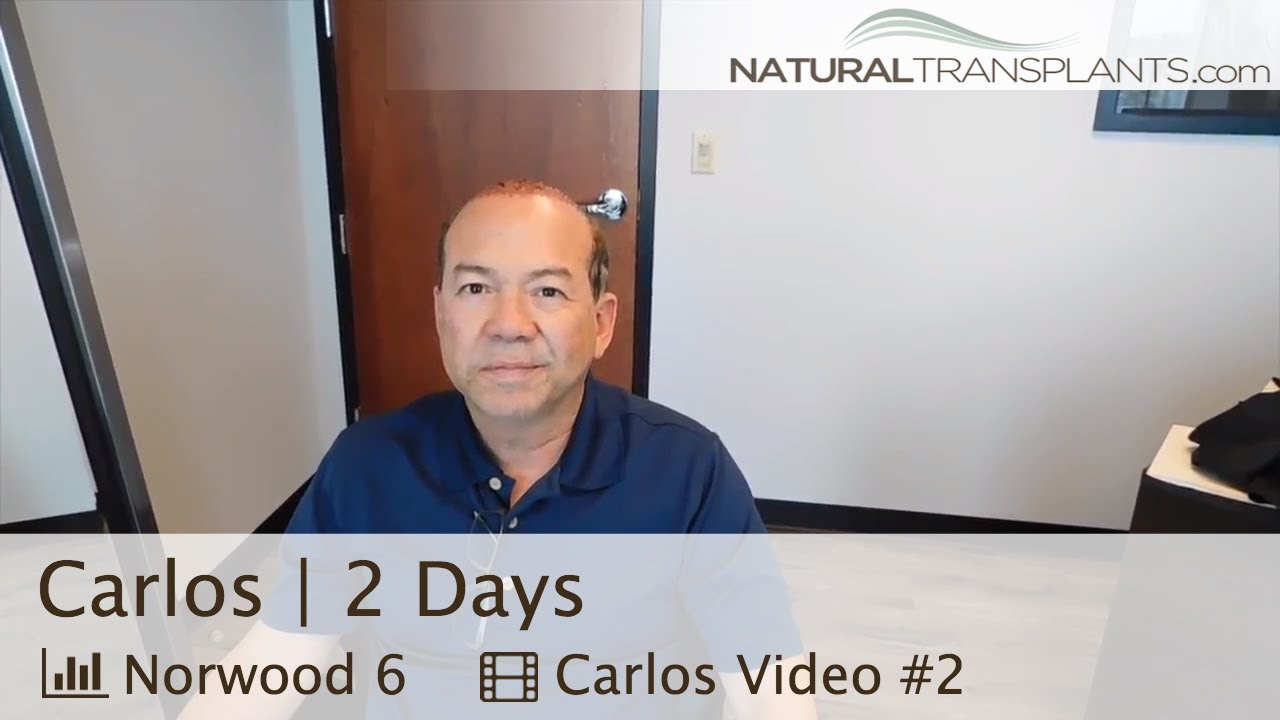 fue hair transplant month by month Male Pattern Baldness Cure | Baldness Cure (Carlos)