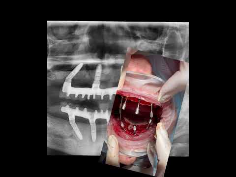 All on 4 / All on four - протезирование всех зубов на 4 имплантах за 1 день с постоянным протезом