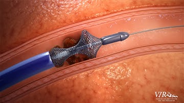 Vascular Institute of the Rockies Introduces FlowTriever Technology to Treat Pulmonary Embolisms