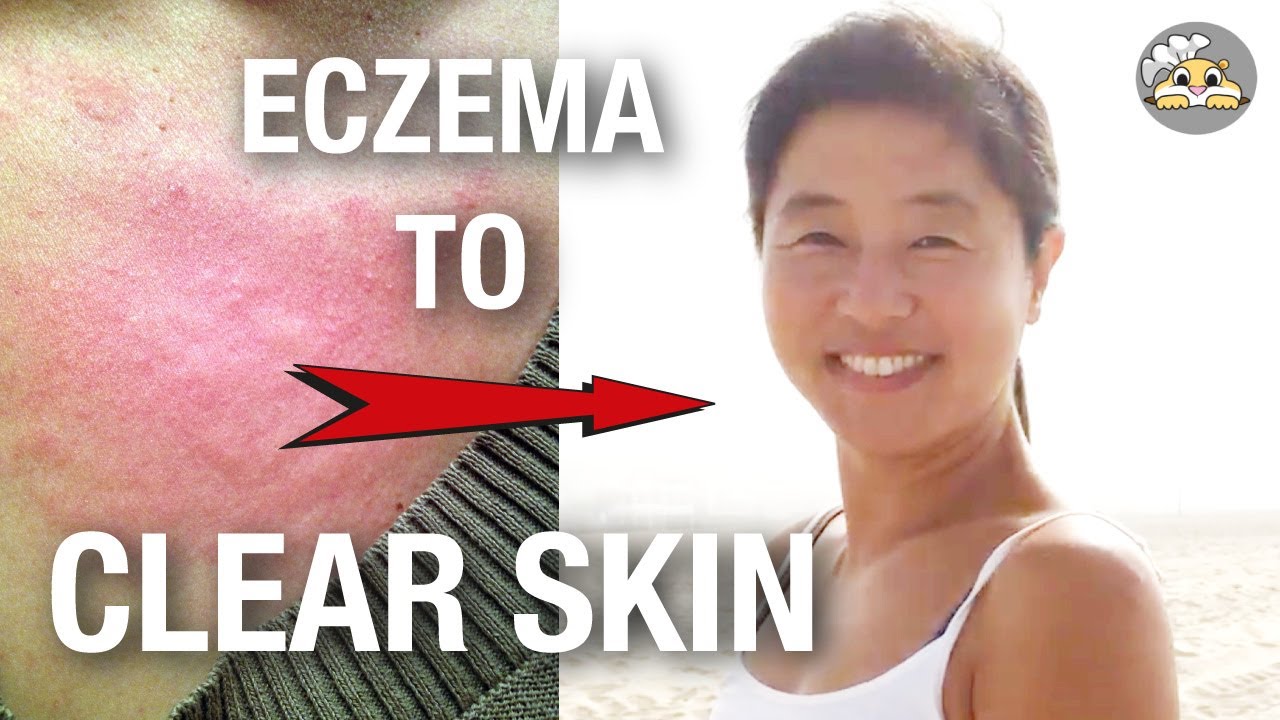 Eczema to Clear Skin (my story) YouTube