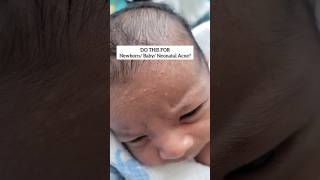 Tips To Treat Newborn/ Neonatal Acne: How To Cure It Naturally #shorts #newborn