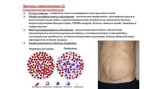 УЗИ. Доктор Иогансен. Выпуск 61. Спленомегалия и диффузные изменения селезенки. Часть 1.