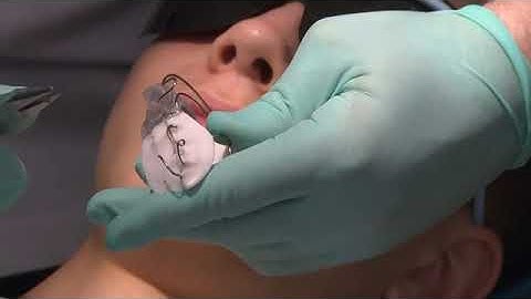 End of Phase One Bionator