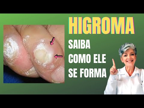 Vídeo: Higroma No Dedo - Causas, Sintomas E Tratamento