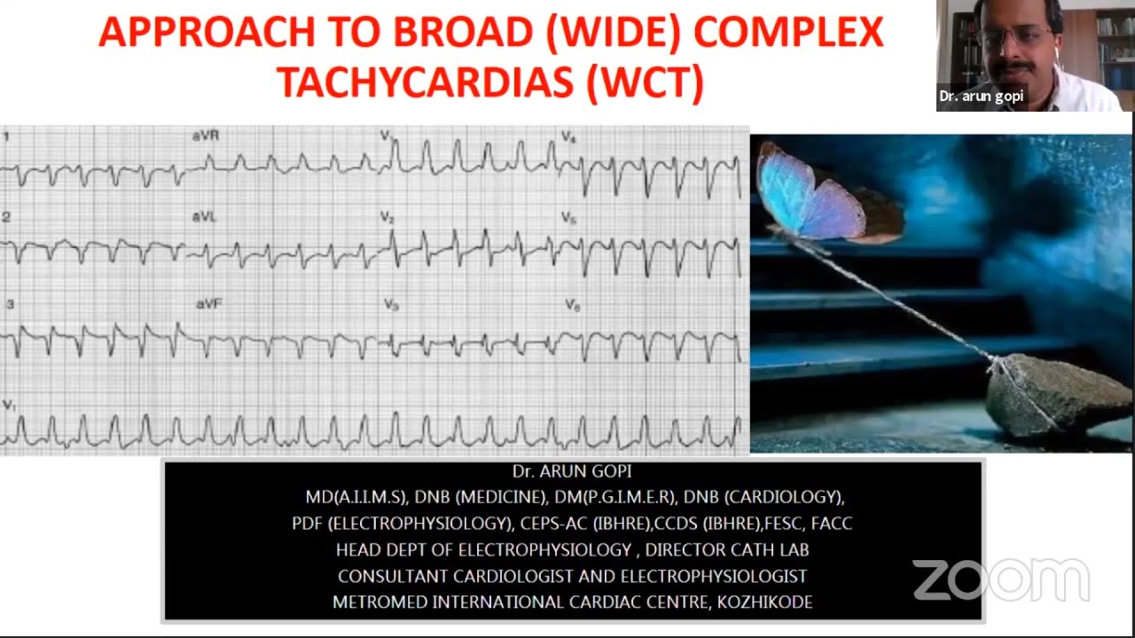 Approach to Broad(Wide) Complex Tachycardiaa(WCT) - Dr.ArunGopi