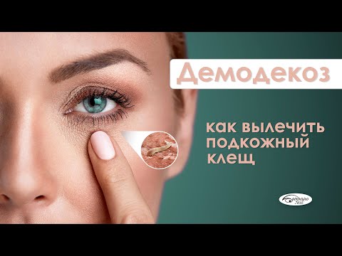 ДЕМОДЕКОЗ: как распознать и избавиться от клеща