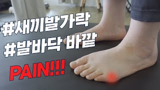 매일 5분!!! 걸을 때, 신발 신을 때 발바닥, 발가락 통증이 있다면 무조건 보셔야 합니다.(발가락 뼈 돌출, 굳은 살, 피부 빨갛게 부움)(HOW TO FIX A BUNION)