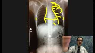 Clinical Cases: Chest Xray discussion