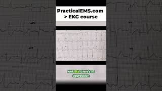 Lateral Wall MI: Identify Heart Issues with This EKG Reading! #shorts