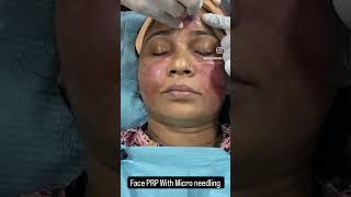 Revitalize Your Skin: Face PRP with Micro-Needling by Dr. Arun Panda in Navi Mumbai