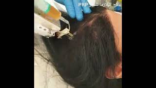 بلازما الشعر مجموعة مشافي استاثيكا لزراعة الشعر والتجميل في اسطنبول للأستفسار أكثر 00905524257158