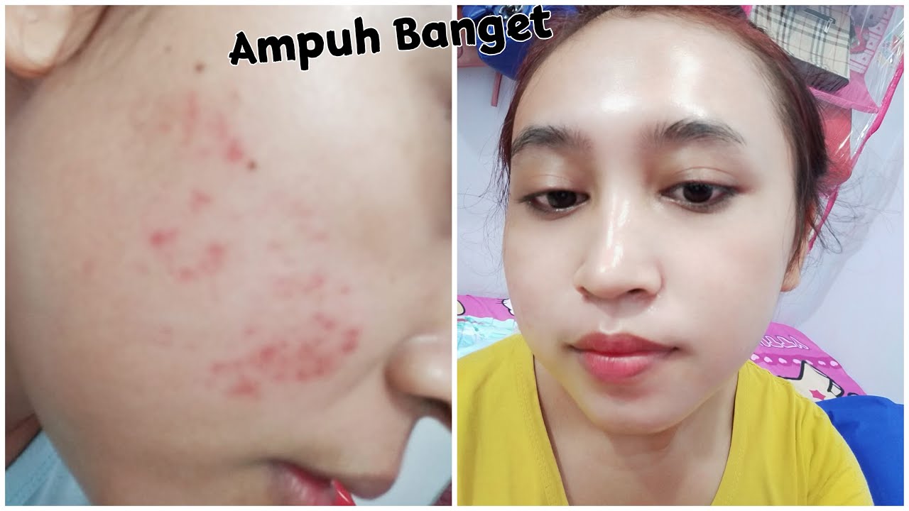 Tips Menghilangkan Kulit Kemerahan & Bekas Jerawat Dalam