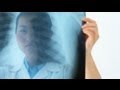 Stage 1 and Stage 2 Lung Cancer - YouTube