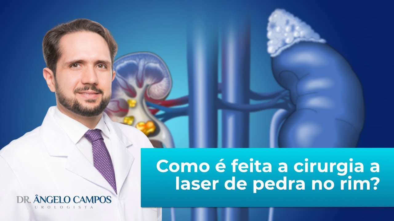 Como é feita a cirurgia a laser de pedra no rim? - YouTube