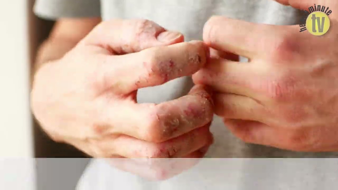 VIDEO: Severe chronic hand eczema patients are more willing to make time for treatment