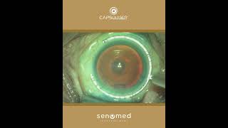 Kapsülotomide Aradığınız Tüm Özellikler, Capsulaser. Teknolojisiyle Mümkün