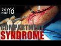 Ultimate atls 10 compartment syndrome and musculoskeletal trauma