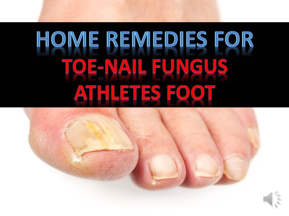All Natural Home Remedies For Toenail Fungus All Natural Home Remedies For Toenail Fungus