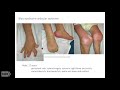 Monogenic Granulomatous Inflammatory Diseases