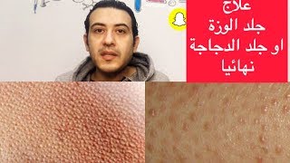 العلاج النهائي لجلد الوزه ..(أسباب جلد الوزه-علاج جلد الوزة )