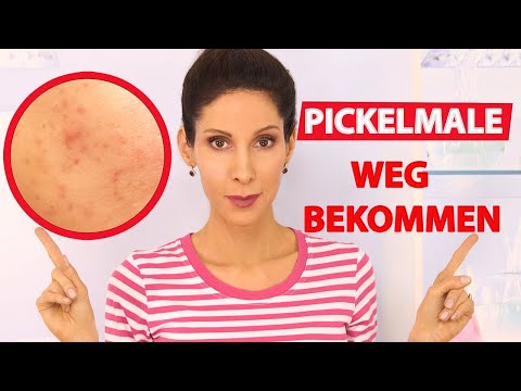 Video: Helfen Augentropfen bei Pickelrötungen?