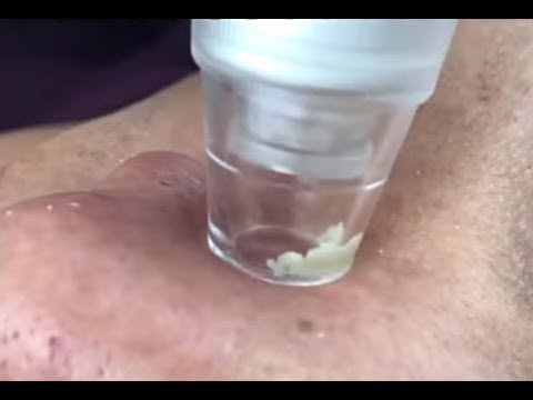 小鼻の白いアレ 角栓 を吸い出すマシーン Youtube