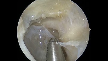 Optic Nerve Decompression