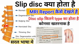 Slip disc (disc prolapse) क्या होता है|| स्लिप डिस्क कितने type की होती है ||MRI report कैसे देखेंगे screenshot 5