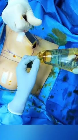 Breast implant insertion #shorts