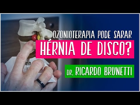 Ozonioterapia Pode Sarar Hernia De Disco Dr Ricardo Brunetti