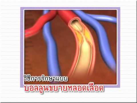 โรคเส้นเลือดหัวใจอุดตัน ทุกนาทีคือชีวิต