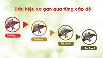 Dấu hiệu xơ gan F1, F2, F3, F4