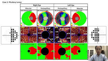 OCT and OCT angiography in optic neuropathies