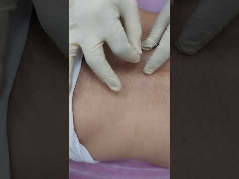 جلسة نبض الكتروني اسفل الظهر