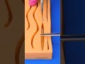 Perfect Medical Stitching Up Close – So Satisfying to Watch! ✂️✨