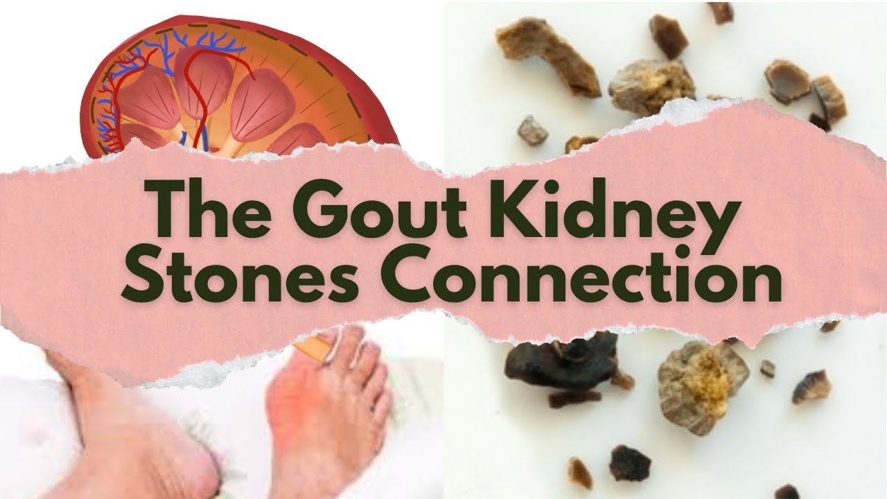 The Gout And Kidney Stones Connection YouTube The Gout And Kidney Stones Connection YouTube