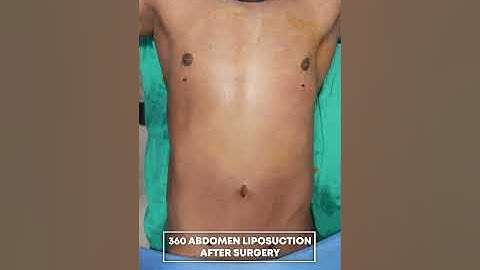 360 Abdomen Liposuction #shorts