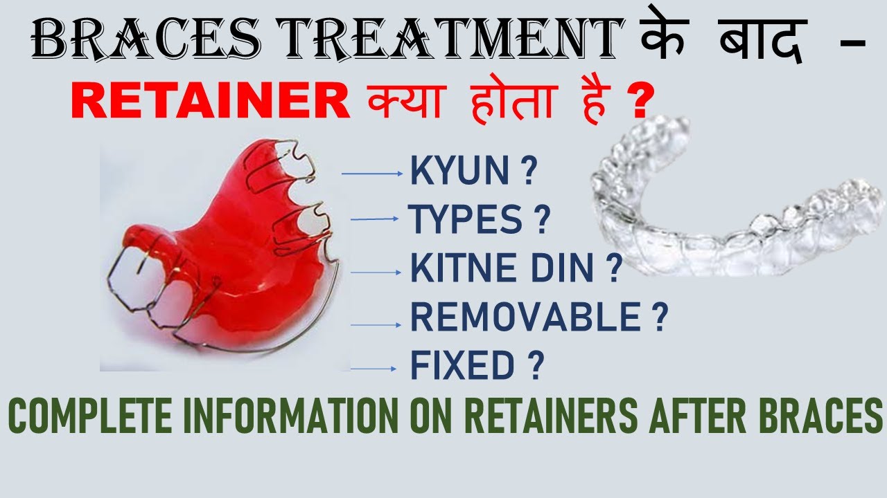 Braces Treatment Ke Baad Retainer Kya Hota Hai Complete Information