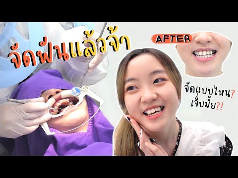 อุ้มจัดฟันแล้ววว!! | จัดแบบไหน จัดที่ไหน เจ็บมั้ย?! บอกทุกรายละเอียด | OUMTTP